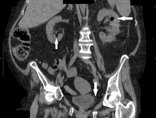 Figure 2 The axial non-contrast-enhanced computed tomography scan showing the presence of gas in pelvicalyceal systems of both kidneys (white arrows) and gas foci in the bladder wall. CT scans were taken at admission to the hospital.