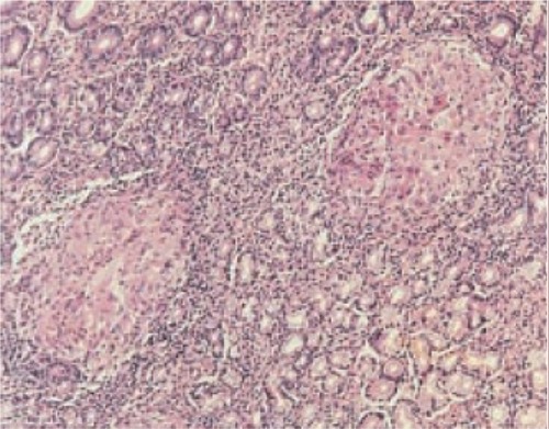 Figure 3 Granulomas in Crohn’s disease. Hematoxylin and eosin staining on the stomach shows gastric mucosal biopsy containing two characteristic granulomas (10×).