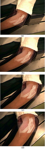 Figure 9. Time-sequentially generated images in the data-fusion display. The volume data of the mobile 3D-CT was superimposed onto the live video image according to the varying direction of the display. [Color version available online.]