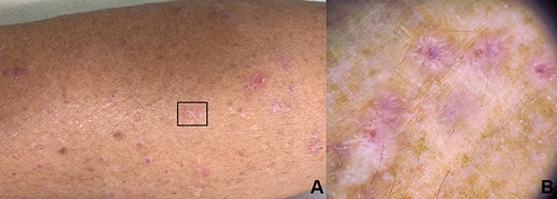 Figure 7 (A) Clinical image of lichen planus, square indicates (B) dermoscopic image showing purplish background, dotted and linear vessels in peripheral distribution, and Wickham striae (x10 original magnification).