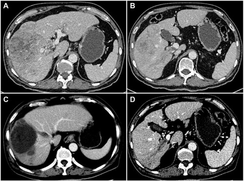 Figure 2 Computed tomography image of the liver obtained from a 55-year-old male patient with a history of hepatitis B for 30 years. Contrast-enhanced CT imaging showed the presence of hepatocellular carcinoma with tumor thrombus in the right branch of the hepatic and portal veins (A and B). After 6 months of oral sorafenib combined with TACE, contrast-enhanced CT imaging showed tumor necrosis in the liver, and no blood supply was seen in the hepatic vein and PVTT (C and D).