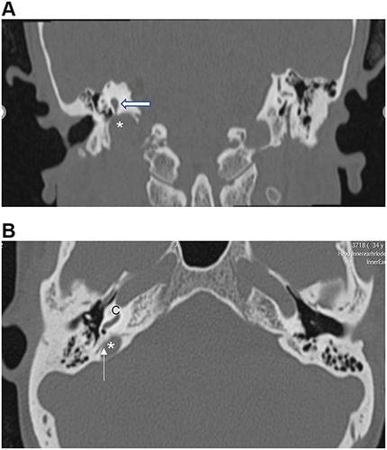 Figure 3 Computed tomography (CT) of the temporal bone (thickness 0.75 mm). Coronal CT image confirms the absence of a bony separation of the right jugular bulb (asterisk) and the posterior semicircular canal (arrow) (C = cochlea). (A) Axial cuts showing dehiscence between the the jugular bulb (asterisk) and the posterior semicircular canal (arrow) (B).