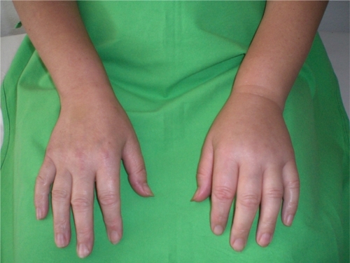 Figure 1 Subcutaneous edema on the left hand of a patient with HAE-C1-INH.