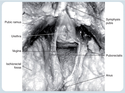 Figure 2. Intact puborectalis muscle in a fresh cadaver, dissected from caudally.The vulva, mons pubis, clitoris, perineal muscles and perineum to the anus, as well as peri- and postanal skin and and some of the fibrofatty tissue of the ischiorectal fossa have been removed to allow access to the puborectalis muscle.Reproduced with permission from Citation[61].