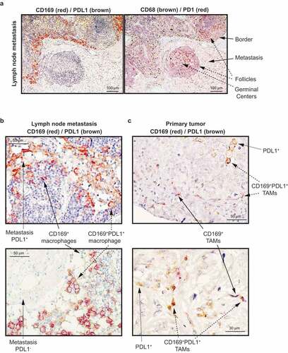 Figure 2. Immunohistochemical staining of CD169, PDL1 and CD68 in primary human breast tumors with paired lymph node metastases. (a) CD169 expression (red) and PDL1 expression (brown) (left) and CD68 expression (brown) and PD1 expression (red) (right) in lymph node metastases of breast cancer patients. Arrows point to the indicated histological structures. (b) CD169 expression (red) and PDL1 expression (brown) in lymph node metastases of breast cancer patients. The images show two metastases representing a PDL1+ (upper) and a PDL1− (lower) metastasis. Arrows point to single PDL1+ malignant cells, or co-expressing CD169+ PDL1+ macrophages. (c) CD169 expression (red) and PDL1 expression (brown) in primary tumor. Arrows point to single PDL1+ malignant cells, single CD169+ tumor associated macrophages (TAMs) or co-expressing CD169+ PDL1+ TAMs. The images show two representative primary tumors