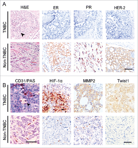 Figure 4. The expression of Twist1 in human TNBC and non-TNBC. (A) Morphological characteristics and genotypes of human TNBC and non-TNBC. H&E staining indicates that TNBC tumor nests comprise poorly differentiated small tumor cells, and there is necrosis in the center of a tumor nest (black arrow). Human TNBC tumors do not express ER, PR, orHER2. (B) PAS and CD31double staining showed that TNBC has more VM channels compared with non-TNBC. The arrow indicates a VM channel that is formed by PAS-positive matrix and tumor cells in TNBC. IHC staining indicates that TNBC tumors express higher levels of HIF-1α, MMP2 and Twist1 than non-TNBC tumors.
