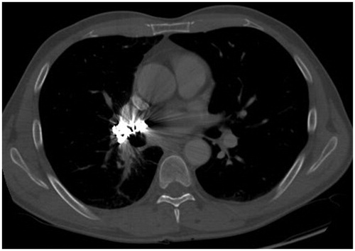 Figure 3. Thoracic CT scan image after the pulmonary artery embolisation procedure. Contrast-enhanced CT image with soft-tissue window showing multiple coils embolised to the right main pulmonary artery, as well as a partially decreased tumour and reduced occlusion of the right lower lobe bronchus.