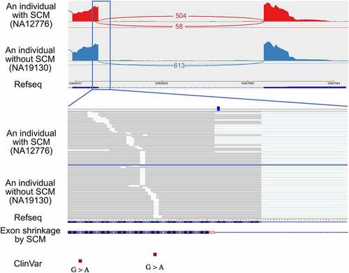 Figure 3. An example of an exon shrinkage event identified in the exon 5 of PSMB9, which was activated by the transition of the SCM (rs17213861) from C-to-T so that the novel donor splice site was created. The upper panel shows the Sashimi plot of the shrunken exon and downstream exon observed in individuals with and without the SCM from top to bottom. Each number represents the number of exon-exon junction reads. Sample IDs are shown in parentheses. The lower panel shows a close-up view of the shrunken exon and the position of the SCM. The red squares at the bottom represent pathogenic variants reported in ClinVar.