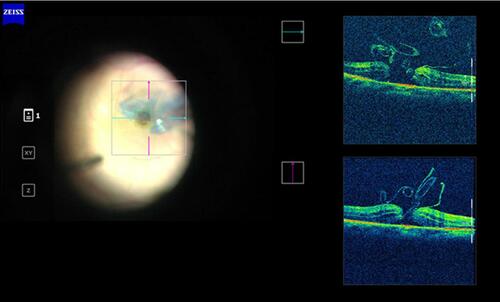 Figure 2 Intraoperative SD OCT image of inverted ILM flap being manipulated into the MH. The ILM flap segments are seen clearly on the OCT scan.Abbreviations: ILM, internal limiting membrane; MH, macular hole; OCT, optical coherence tomography.