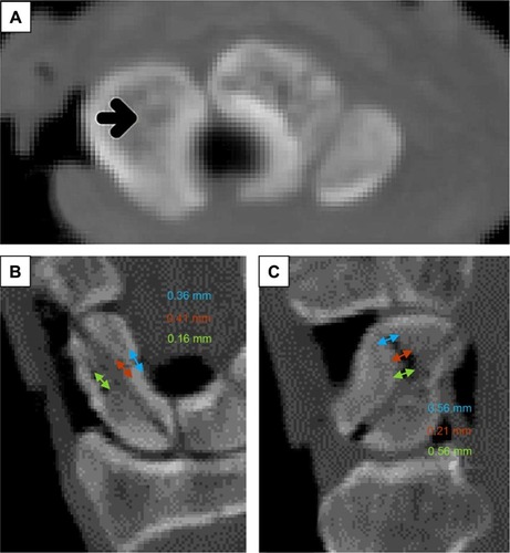 Figure 3 CT imaging of a scaphoid fixed with ASS with fracture gap measurement.