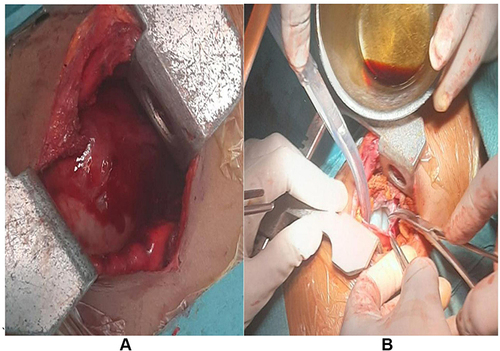 Figure 3 (A) Thoracotomy was done and the outer layer of the cyst is visualized during the procedure. (B) Intraoperative image showing the hydatid cyst with its visible covering layer.