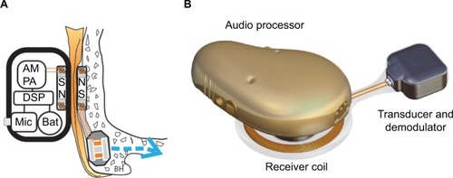 Figure 1 The Bone Conduction Implant System.Notes: (A) An illustration of the principal design of an active transcutaneous bone conduction device (BCD) showing the audio processor (AP) components, the wireless induction link with retention magnets (N=north pole and S=south pole), and the transducer in the bone. The AP unit comprises microphones (Mic), a battery (Bat), a digital sound processor (DSP), a power amplifier (PA), and amplitude modulation (AM). (B) External view of the bone conduction implant (BCI).