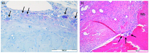 Figure 2. (a) High-power magnification (x40) light microscopy of section of the calcaneus from a specimen in the ZA group after 3 weeks subjected to TRAP enzyme histochemistry hematoxylin nuclear staining. Arrows indicate counted osteoclasts. (b) High-power magnification (x40) light microscopy of H&E stained section of the tendon–bone interface from a specimen in the control group after 6 weeks with bone resorption lacunae (arrows) in the tunnel wall containing osteoclasts. There is adjacent new woven bone (Wb) formation. Scale bars =500 µm.