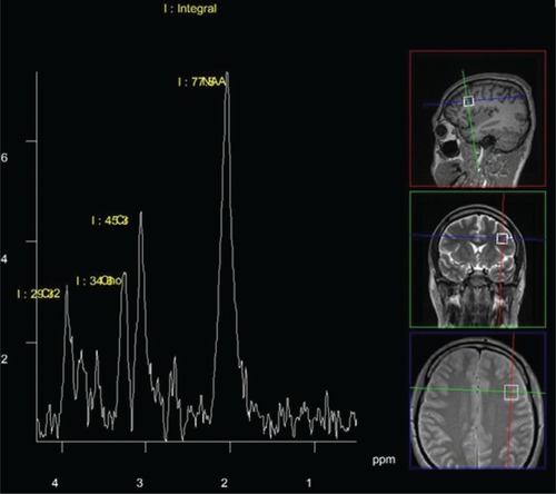 Figure 1 A typical 1H spectrum and the spectroscopic volume of interest: left dorsolateral prefrontal cortical region.