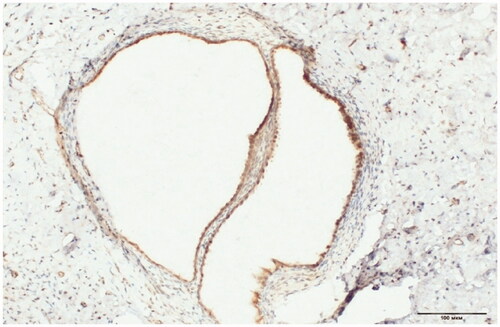 Figure 2. VDR expression in glands and stroma of eutopic endometrium – secretory phase. IHC test × 400.
