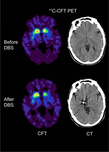 Figure 1 Comparison of 11C-CFT PET imaging before and after deep brain stimulation in patient’s right subthalamic nucleus.