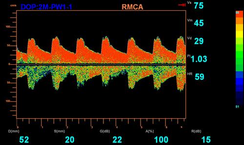 Figure 1 MCA hemodynamics evaluated by TCD. The changes of Doppler waveform and the parameters including Vs, Vm, Vd, and PI are recorded automatically when a 6-second frame of a clearly waveform is obtained.