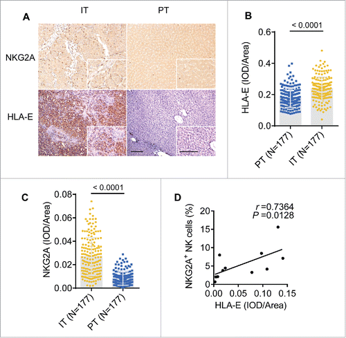 Figure 3. The density of NKG2A and its ligand are increased in the intratumoral regions from HCC patients. (A) Representative micrographs showing NKG2A+ (up) and HLA-E+ (down) cells in the peritumor tissue (right) and intratumor regions (left) of HCC patients. Original magnifications: 10×, 40×, bar = 100 μm. (B, C) Cumulative data are shown (Mann–Whitney non-parametric statistical tests). (D) A positive correlation was observed between integrated optical density (IOD)/area HLA-E+ cells and NKG2A expression (percentage by FACS) in intratumor NK cells from HCC patients (N = 11). Spearman's correlation coefficients (r) and p values are shown.