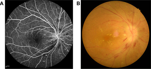 Figure 1 Example of diabetes optic neuropathy seen on fluorescence fundus angiography (A) and fundus camera (B).