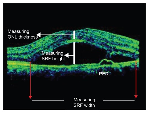 Figure 1 Measurement of SRF dimensions and ONL thickness.