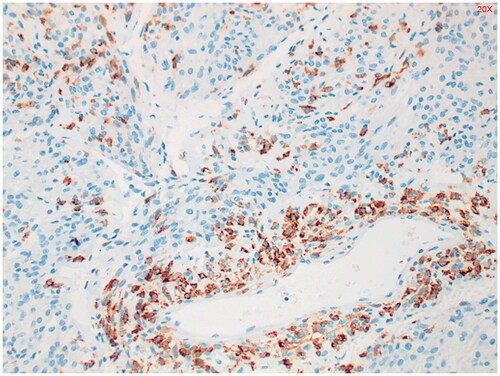 Figure 5. HMB-45 staining. Positive in 94% of PEComa’s.