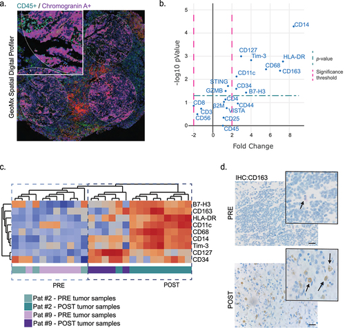 Figure 2. Infiltration of tumor associated macrophages in POST MNA+ neuroblastoma tumors a. Representative image of high-resolution spatial proteomics on neuroblastoma tumors stained for immune cells (CD45+, green) and tumor cells (chromogranin A+, purple). Circles indicate regions of interest (ROI). Red blood cell autofluorescence can be seen between ROI. b. Volcano plot of immune cell related proteins. Unpaired t-tests, p-value <-2 or > 2. c. Heatmap and dendrogram showing unsupervised hierarchical clustering of multiple PRE and POST tumor samples from two patients with MNA+ neuroblastoma, for the proteins that had significantly different expression comparing PRE and POST tumor samples. d. Representative IHC images for TAMs (CD163+ cells in PRE and POST MNA+ tumors from the same patient). Black arrow indicate CD163+ cells. Scale bar = 100 µm.