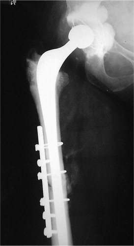 Figure 2. 12 months postoperatively. Long-stem revision and DCP plate applied to the lateral aspect of the femur.