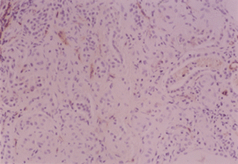 Figure 2. Immunohistochemical staining for endothelial factor VIII of peritubular capillary in FSGS demonstrates a diminished staining.
