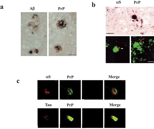 Figure 1. Co-occurrence of CJD with other neurodegenerative diseases. (a). Immunohistochemistry of Co-localization of PrP (brown precipitate) and Aβ (dark blue precipitate) in senile plaques in AD. Expression of PrP was observed, although it was unlikely that PrP directly bound with Aβ. Bar 50 μm. (b). Double labelling of αS and PrP. Upper; immunohistochemistry of experimental scrapie of hamsters. DAB substrate for αS (brown) and DAB-nickel substrate for PrP (dark brown) were used. Lower; double immunofluorescence by confocal microscopy revealed PrP- and αS-immunoreactivities in the plaques were not strictly co-localized. αS immunolabeling was found either isolated (arrow) or in areas of PrP granular deposits (double arrow) or close to PrP plaques (arrowhead). DAB diaminobenzidine, FITC fluorescein isothio-cyanate, Cy3 cyanin 3. Bar 15 μm (c). Double immunofluorescence showed that PrP was not overlapped with either αS nor tau in fully developed inclusions in AD, PD and DLB. Reprinted from Ferrer et al. [Citation7] (a), Haik et al. [Citation8] (b) and Kovacs et al. [Citation10] (c) with permission