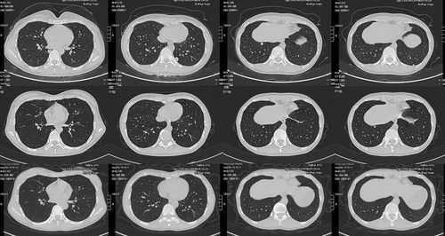 Figure 4 The patient with partial response showing response to the treatment with apatinib.