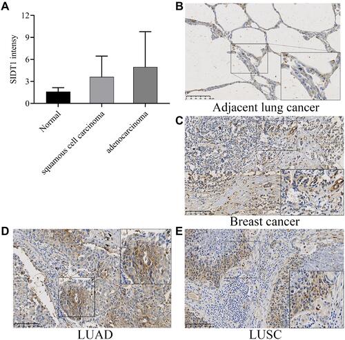 Figure 2 Immunohistochemical staining images of SIDT1 in NSCLC and adjacent lung tissues. In the quantitative score of SIDT1 immunohistochemistry (A) adjacent lung tissues, (B) breast cancer, (C) LUAD, (D) LUSC, (E) SIDT1 expression was higher in tumor cells than in normal adjacent lung tissues. Magnification, x200.