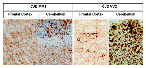 Figure 3. PrPsc deposition in sCJD brain samples. PrPsc immunohistochemistry shows differential PrP deposition in frontal cortex and cerebellum in sCJD MM1 and sCJD VV2 cases. Sections were pre-incubated with PK prior to PrPsc immunohistochemistry. Synaptic pattern of PrPsc deposition in the frontal cortex and molecular layer of the cerebellum characterizes MM1, whereas synaptic and plaque-like PrPsc deposition, mainly in the cerebellum, characterizes VV2.