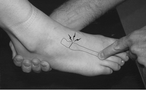 Figure 1. Illustrating the piano key special test for diagnosis of lisfranc injury
