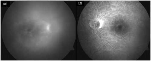 Figure 1. Fluorescein angiography demonstrating 3+ vitreitis and cystoid macular edema RE and cystoid macular edema LE.