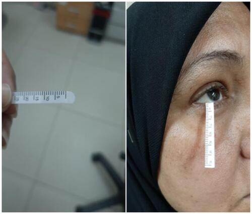 Figure 1 Schirmer test I at right eye of female patient that showed value of less than 15mm at 1st week postoperative.
