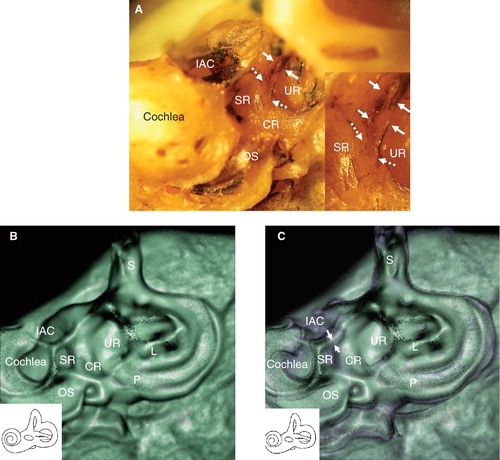 Figure 2. Direction of CT examination and CT findings in the cadaver. (A) This position of the temporal bone is suitable to obtain more accurate CT images of the saccule, saccular duct, and endolymphatic sinus. Note that the remnant membranous labyrinth, shown in black, is visible. Insert: Higher magnification of the groove of the saccular duct (white dashed arrows) and endolymphatic sinus (white arrows). (B) The sulciform groove-like 3D CT image of the saccular duct and endolymphatic sinus of the same specimen as in (A), which was examined in the same direction as in (A) with a bone CT window level. (C) The same specimen as in (A) with CT window levels of bone and soft tissue. The membranous composition of the saccular duct and endolymphatic sinus in purple (white arrows) are surrounded by the artificial shadow of a rendering effect. The details of the aspects are consistent with macroscopic specimens. Purple indicates soft tissue. CR, cochlear recess; IAC, internal auditory canal; L, lateral semicircular canal; OS, osseous spiral lamina; P, posterior semicircular canal; S, superior semicircular canal; SR, saccular recess; UR, utricular recess.