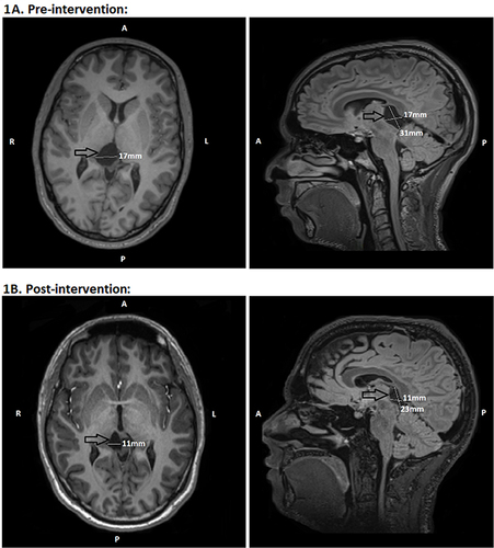 Figure 2 Pre- and post-intervention cranial MRI scans, conducted one year apart. (1A): Axial and sagittal views showing the arachnoid cyst (arrow) impressing on the thalamus and tectum, prior to fenestration. (1B): Axial and sagittal views showing the cyst (arrow) 6 months postoperatively.