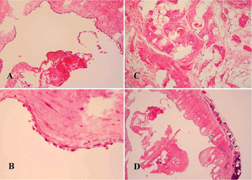 Figure 2. (A) Photomicrograph showing the dilated cystic structures (H & E);original magnification × 100) (B) Higher-power view of the cystic wall showing a lining layer of flattened, elongated endothelial cells (H & E;× 400) (C) Tissue biopsy specimen showing the presence of aggregated red cells in the variablesized lymphatic channels (H & E;× 200) This implies that an irritative incident can cause hemorrhage into the cystic structures, and can then facilitate speedy growth of the mass.(D) Lower-power view of the tumor origin showing the characteristic microscopic picture of intervening fibrous tissue and lymphoid aggregates (H & E; × 40).