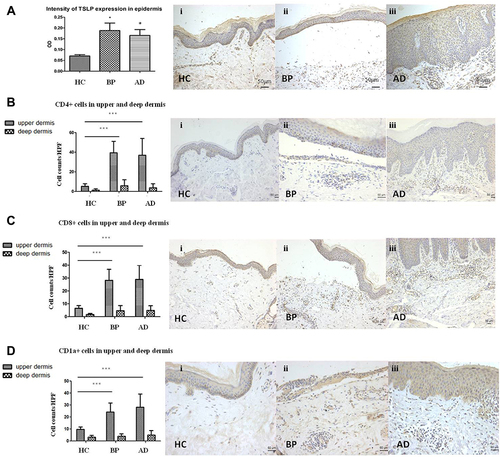 Figure 2 Immunohistochemistry of TSLP, CD4, CD8 and CD1a in normal skin and skin lesions of BP and AD. (A) Expression of TSLP in normal skin and lesions of BP and AD. The mean optical densities (OD) of BP, AD and healthy controls were 0.188±0.10, 0.162±0.08 and 0.07±0.01, respectively (Ai, Aii, Aiii×200). (B–D) The number of CD4+ T cells (B), CD8+ T cells (C) and CD1a cells (D) in upper and deep dermis of normal skin and lesions of BP and AD. (Bi, Biii, Ci, Cii Ciii×100; Bii, Ci, Cii, Ciii×200). *P<0.05 versus HC; ***P<0.001 versus HC.