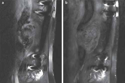 Figure 1. a) tumor at the time of initial diagnosis in July 2008. b) tumor after 18 months of bevacizumab treatment without signs of progression but with visible changes of tumor structure.