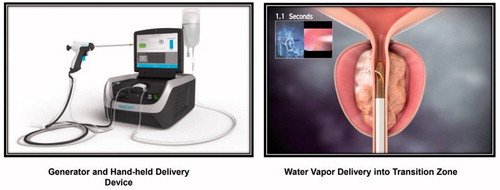 Figure 1. Rezūm™ device. Image taken from Boston Scientific.