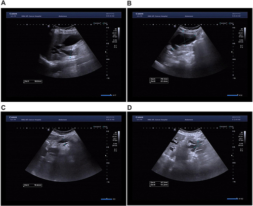 Figure 2 Three-dimensional ultrasound images with lesion in the pancreas on November 12th, 2021. The superior common bile duct was obviously dilated with MW of 1.8 cm (A, dotted line). The gallbladder volume was enlarged with a 7.9 cm long diameter and 4.14 cm front and back diameter (B, dotted line). The main pancreatic duct was also widened with MW of 1.06 cm (C, dotted line). The lesion located in head of pancreas area was 1.71 cm (D, dotted line) in MD.