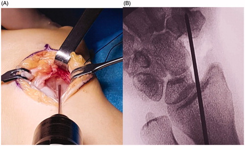 Figure 2. (A,B) A hole was placed into the trapezium to host the distal carpal stem.