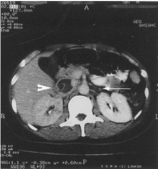 Figure 1. Contrast enhanced CT showing renal vein (arrow) and IVC thrombosis (arrow head).