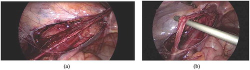 Figure 2. Laparoscopic operative views: (a) Dissection medial and lateral to the testicular vessels. (b) Testicular vessels gained length after dissection.