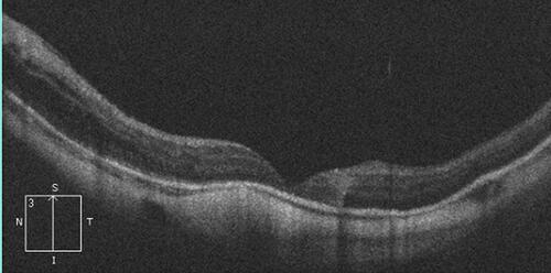 Figure 3 Post-operative SD-OCT image in a 5-line raster scan mode of the left macula of a 67-year old male patient. The patient presented with retinal detachment and macular hole. The axial length of the left eye measured 27 mm. Post-operatively he had retinal re-attachment and V-type closure of the macular hole. Note the dome-shaped macula, posterior bowing of the globe and significant thinning of the choriocapillaris, which are consistent with high myopia. His final BCVA was 0.05 decimal units.
