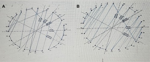 Figure 1 Scoring in Roth 28 Hue test showing protan (A) and deutan (B) deficiencies.