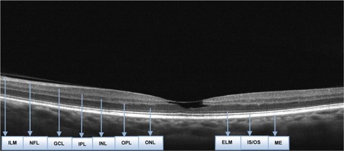 Figure 2 Optical Coherence Tomography of the left eye.