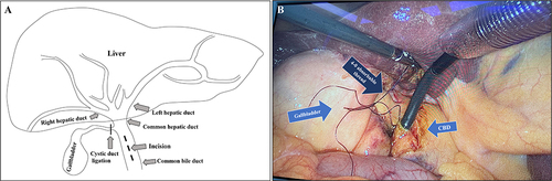 Figure 2 Removal of CBD stones through choledocholithotomy. (A) The anterior wall of the CBD was cut directly approximately 10–15 mm after (B) 4–0 absorbable thread was used to suspend the anterior wall longitudinally. The CBD was explored via choledochoscopy.