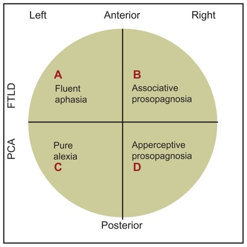 Figure 6 A simple, schematic diagram of the relative loci of associative and apperceptive prosopagnosia, fluent aphasia, and pure alexia. Our own case history of PCA/apperceptive prosopagnosia relates to area D in the ventral part of the right posterior area of the brain.